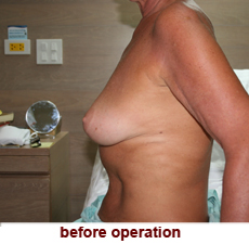 plastic-surgery-breast-lift